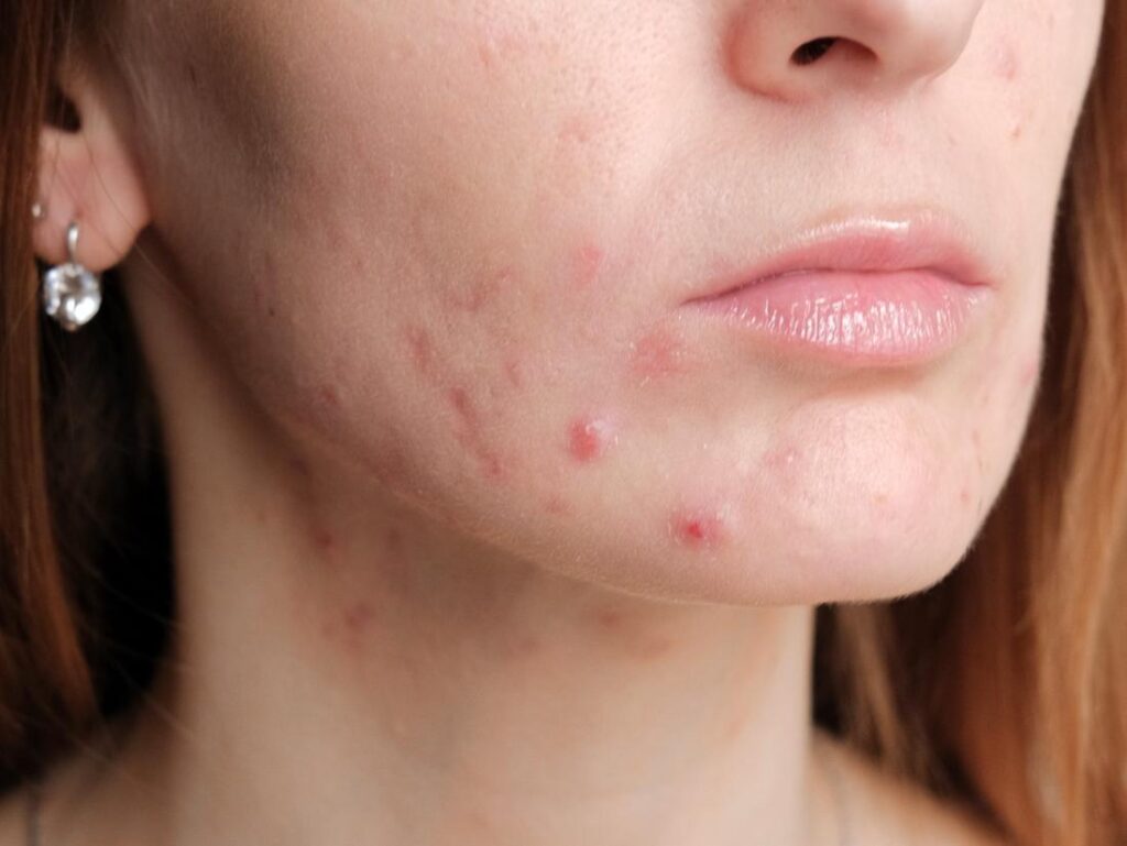Control Your Acne