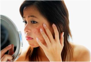 Woman checking her acne on the mirror